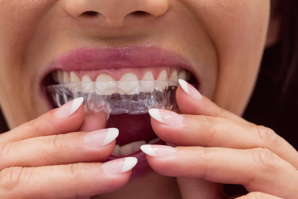 Invisalign sigue a la cabeza en la ortodoncia invisible.